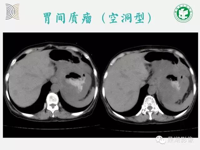 【病例】小肠胃肠道间质瘤1例CT影像表现