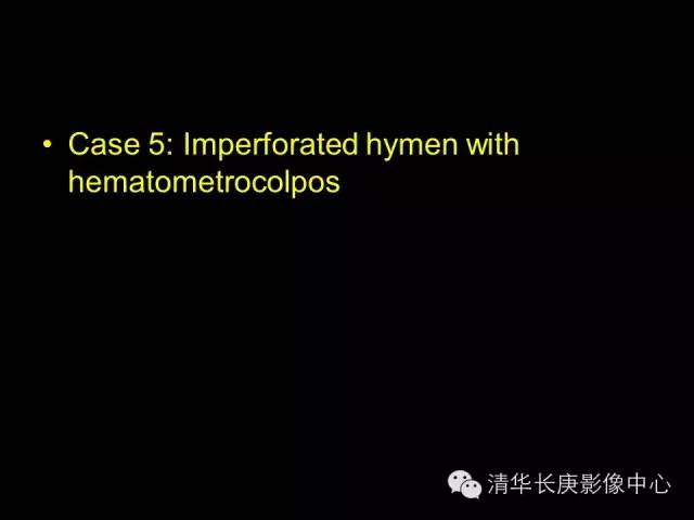 【病例】先天性阴道闭锁1例CT影像表现