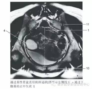 男女盆腔的一些重要影像数据