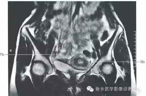 男女盆腔的一些重要影像数据