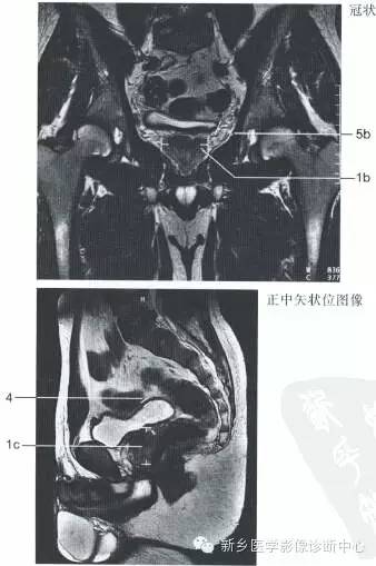 男女盆腔的一些重要影像数据