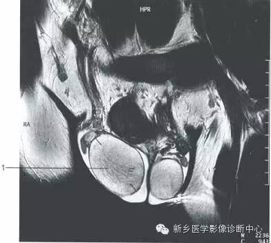 男女盆腔的一些重要影像数据