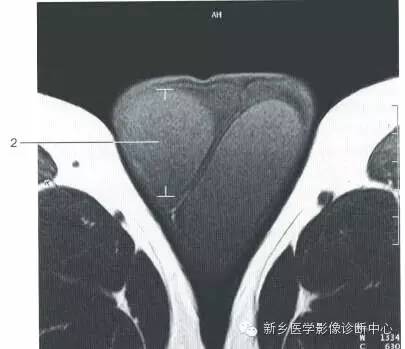 男女盆腔的一些重要影像数据