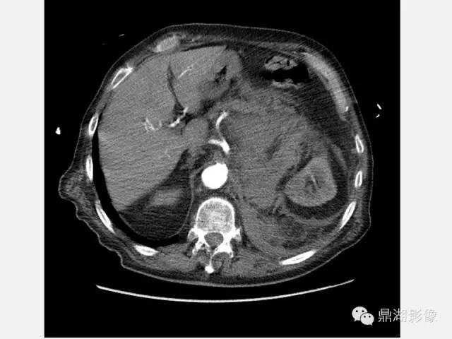 【病例】巨大腹主动脉瘤破裂1例CT影像表现