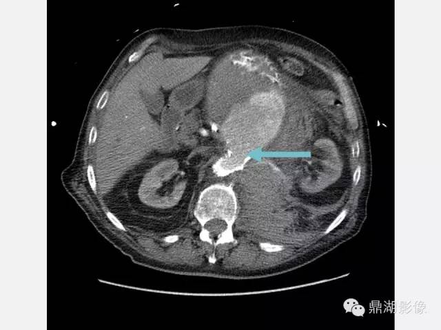 【病例】巨大腹主动脉瘤破裂1例CT影像表现