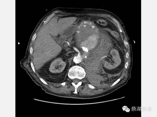 【病例】巨大腹主动脉瘤破裂1例CT影像表现