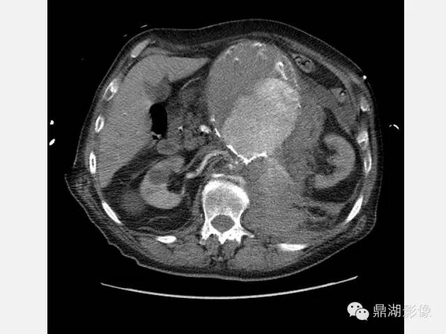 【病例】巨大腹主动脉瘤破裂1例CT影像表现