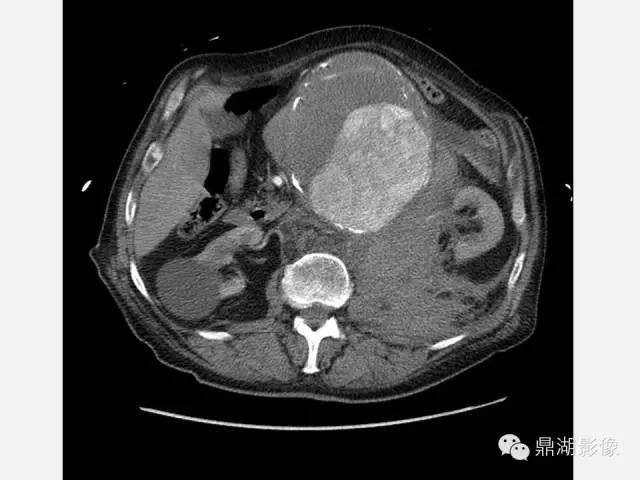 【病例】巨大腹主动脉瘤破裂1例CT影像表现