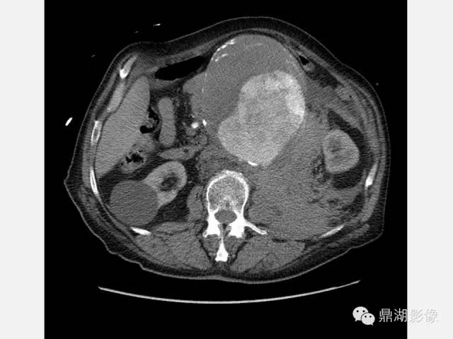 【病例】巨大腹主动脉瘤破裂1例CT影像表现