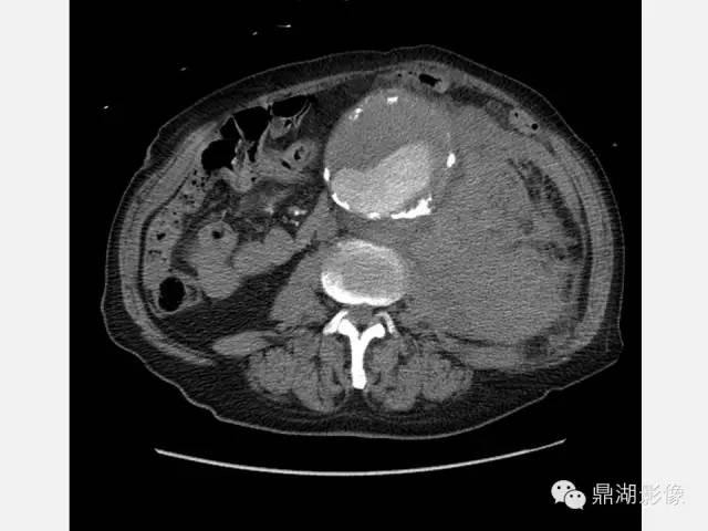 【病例】巨大腹主动脉瘤破裂1例CT影像表现