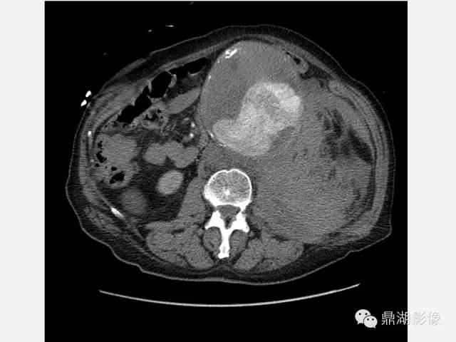 【病例】巨大腹主动脉瘤破裂1例CT影像表现