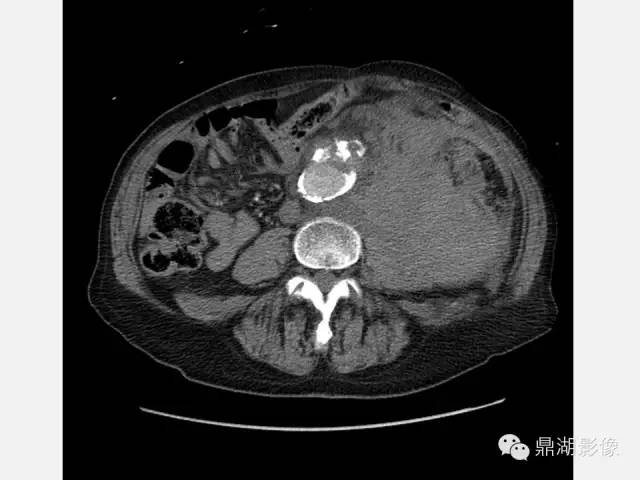 【病例】巨大腹主动脉瘤破裂1例CT影像表现