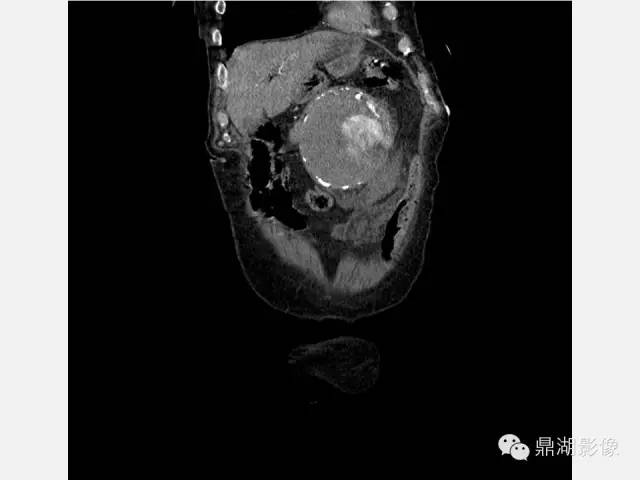 【病例】巨大腹主动脉瘤破裂1例CT影像表现