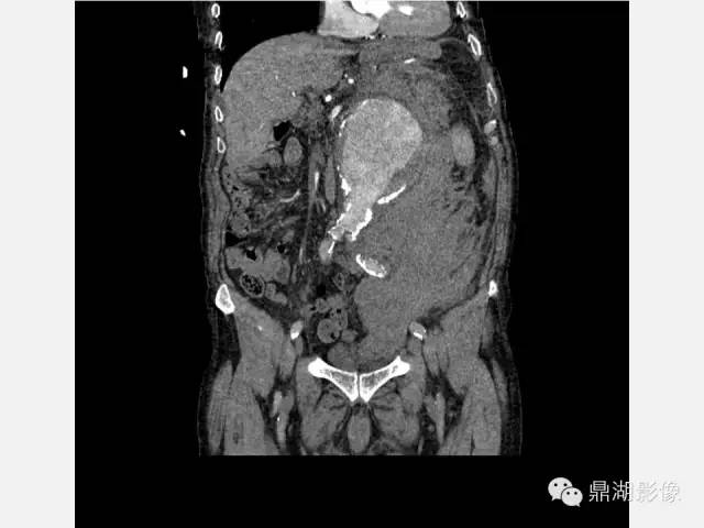 【病例】巨大腹主动脉瘤破裂1例CT影像表现
