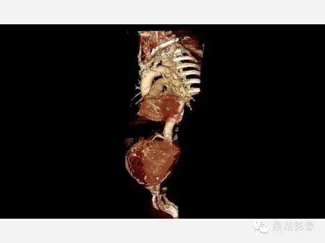 【病例】巨大腹主动脉瘤破裂1例CT影像表现
