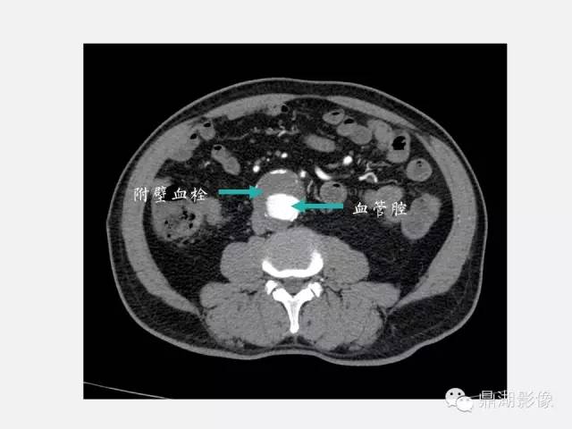 【病例】巨大腹主动脉瘤破裂1例CT影像表现