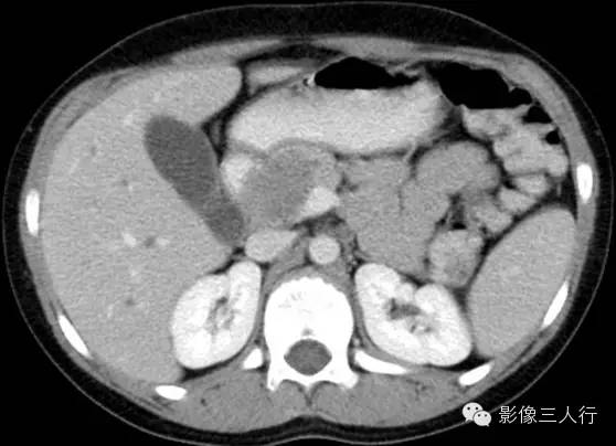 胰腺实性假乳头状瘤Solid Pseudopaillary Neoplasm