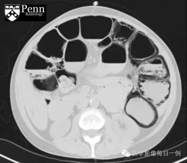 【病例】肠壁积气1例影像表现