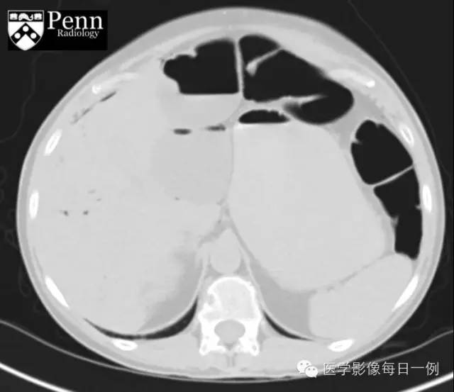 【病例】肠壁积气1例影像表现