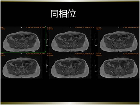 【病例】腹膜恶性间皮瘤1例MR影像表现