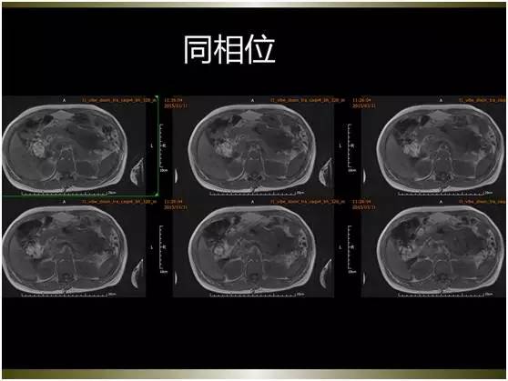【病例】腹膜恶性间皮瘤1例MR影像表现