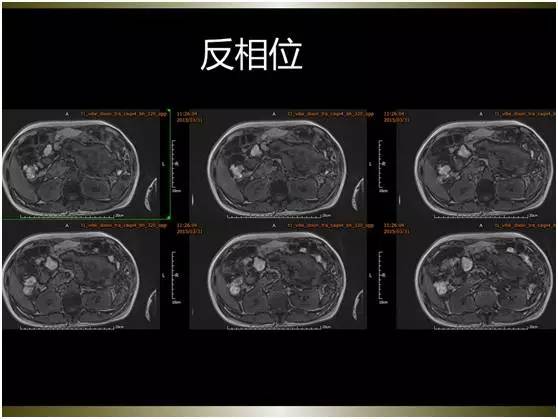 【病例】腹膜恶性间皮瘤1例MR影像表现