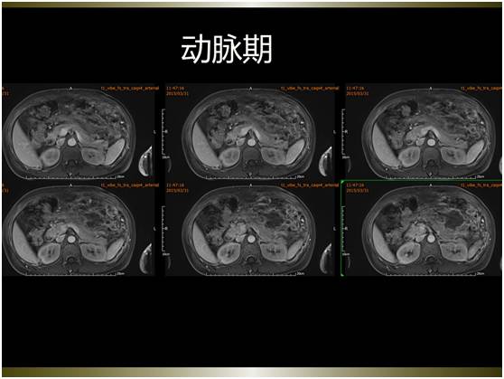 【病例】腹膜恶性间皮瘤1例MR影像表现