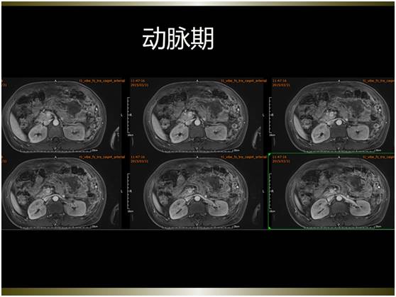 【病例】腹膜恶性间皮瘤1例MR影像表现