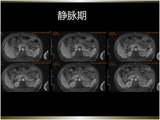 【病例】腹膜恶性间皮瘤1例MR影像表现