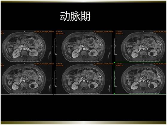 【病例】腹膜恶性间皮瘤1例MR影像表现