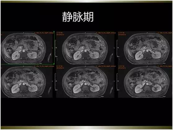 【病例】腹膜恶性间皮瘤1例MR影像表现
