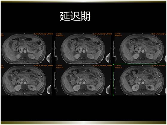 【病例】腹膜恶性间皮瘤1例MR影像表现