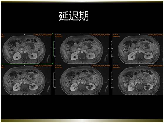 【病例】腹膜恶性间皮瘤1例MR影像表现