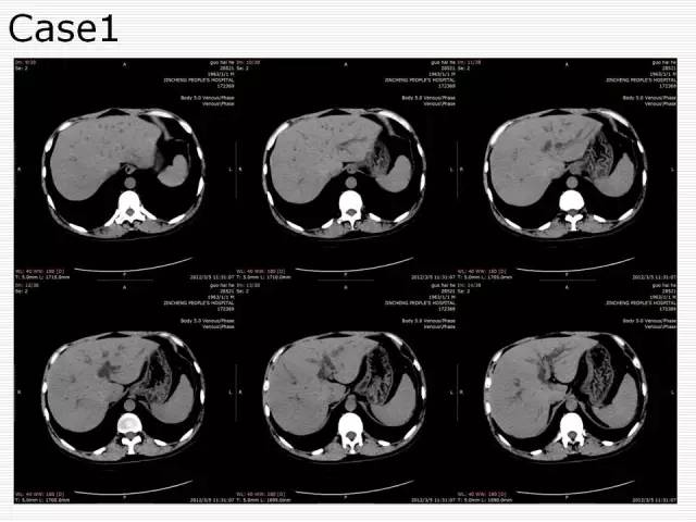 【病例】胰腺囊性病变6例CT影像表现与鉴别