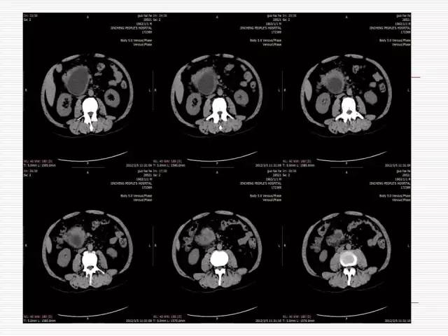【病例】胰腺囊性病变6例CT影像表现与鉴别