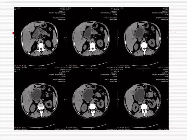 【病例】胰腺囊性病变6例CT影像表现与鉴别