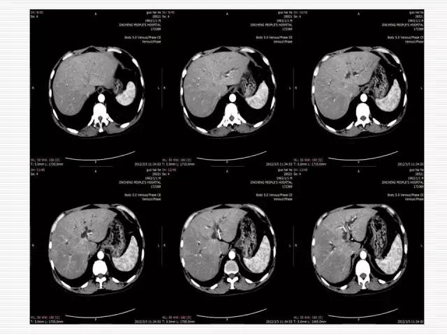 【病例】胰腺囊性病变6例CT影像表现与鉴别