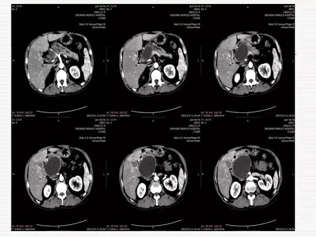 【病例】胰腺囊性病变6例CT影像表现与鉴别