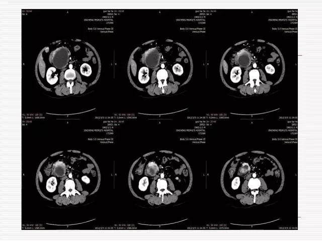 【病例】胰腺囊性病变6例CT影像表现与鉴别