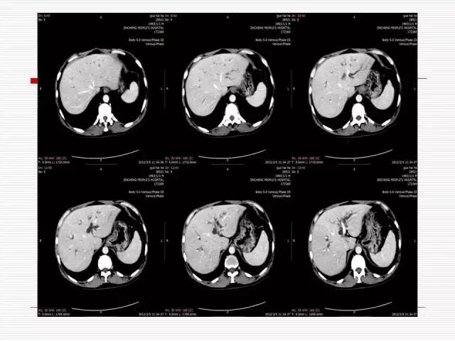 【病例】胰腺囊性病变6例CT影像表现与鉴别