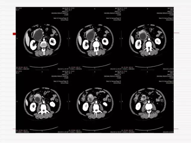 【病例】胰腺囊性病变6例CT影像表现与鉴别