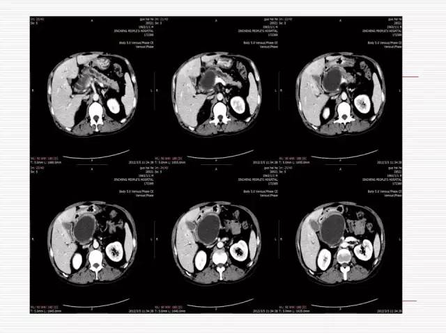 【病例】胰腺囊性病变6例CT影像表现与鉴别