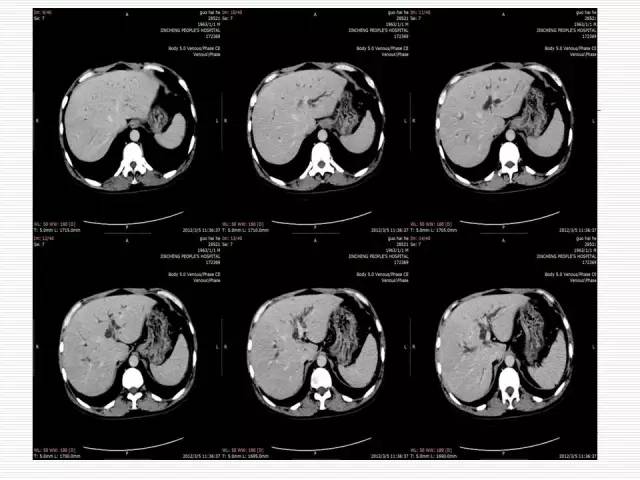 【病例】胰腺囊性病变6例CT影像表现与鉴别