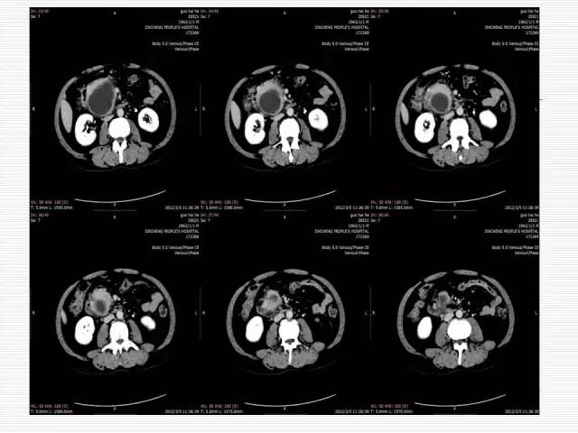 【病例】胰腺囊性病变6例CT影像表现与鉴别