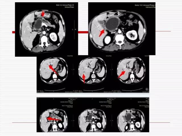 【病例】胰腺囊性病变6例CT影像表现与鉴别