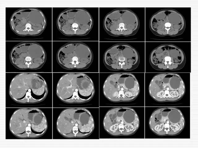 【病例】胰腺囊性病变6例CT影像表现与鉴别