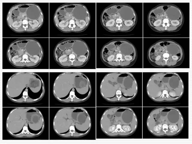 【病例】胰腺囊性病变6例CT影像表现与鉴别