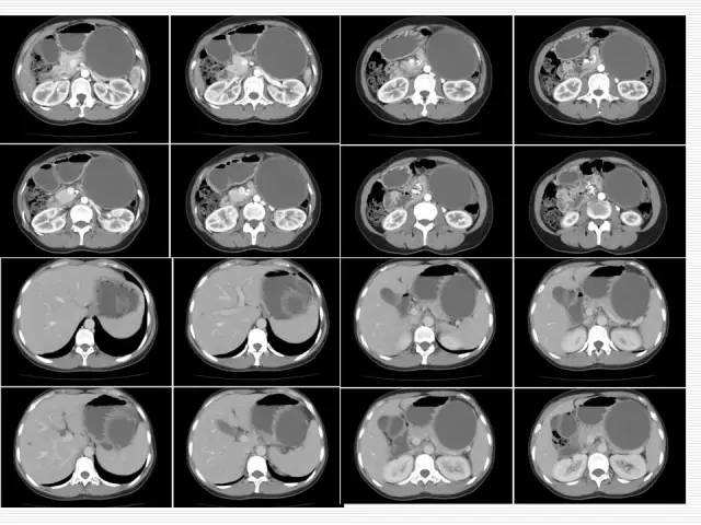 【病例】胰腺囊性病变6例CT影像表现与鉴别