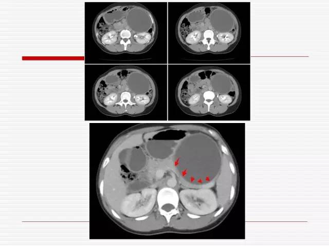 【病例】胰腺囊性病变6例CT影像表现与鉴别