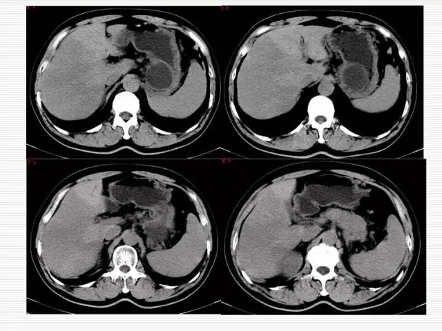 【病例】胰腺囊性病变6例CT影像表现与鉴别
